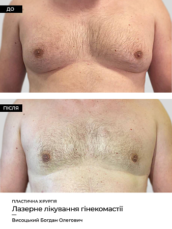 Гинекомастия фото до и после процедуры