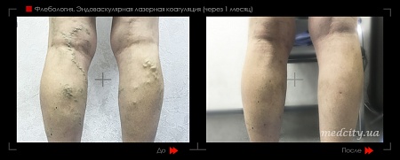 Эндоваскулярная лазерная коагуляция9 фото до и после процедуры