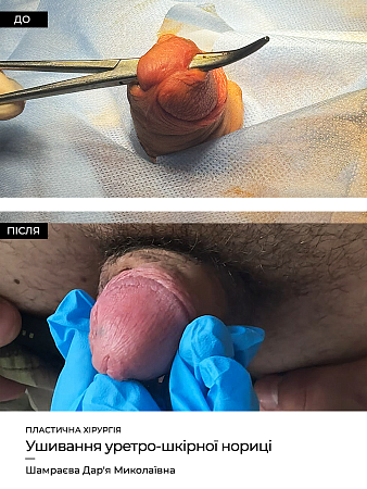 Лазерное удаление кондилом Бушке фото до и после процедуры