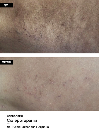 Склеротерапия 12 фото до и после процедуры