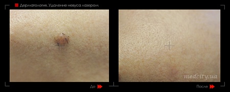 Удаление новообразования лазером 3 фото до и после процедуры