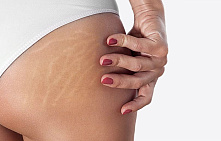 Лазерне видалення розтяжок