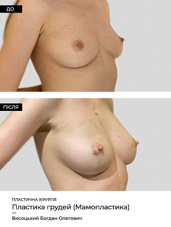 Маммопластика 29 фото до и после процедуры