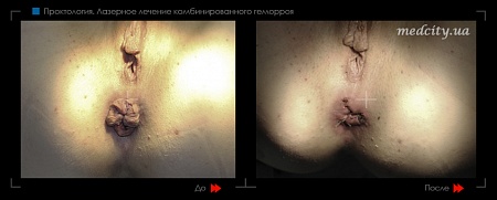 Удаление геморроя лазером 4 фото до и после процедуры