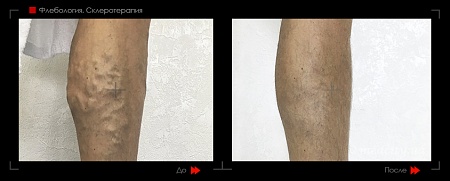 Склеротерапия 11 фото до и после процедуры