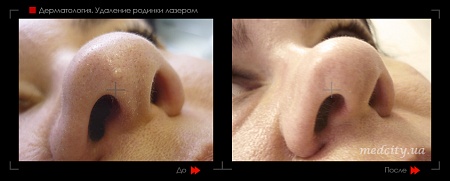Удаление родинок 49 фото до и после процедуры