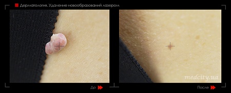 Удаление новообразования лазером 6 фото до и после процедуры