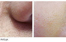 Как убрать шрам на лице