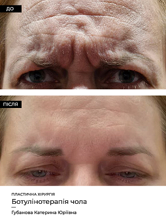 Коррекция морщин фото до и после процедуры