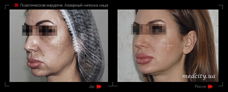Липолиз лица 6 фото до и после процедуры