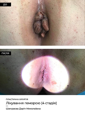 Удаление геморроя лазером 25 фото до и после процедуры