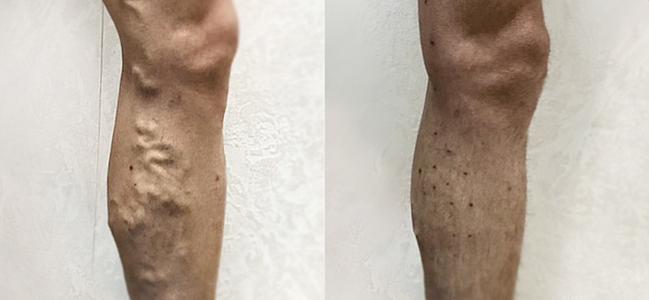 Минифлебэктомия