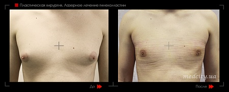 Гинекомастия 36 фото до и после процедуры