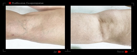 Склеротерапия 25 фото до и после процедуры