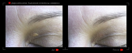 Удаление ксантомы 4 фото до и после процедуры