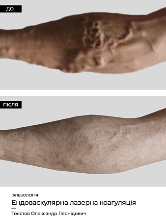 Эндоваскулярная лазерная коагуляция19 фото до и после процедуры