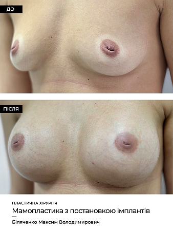Маммопластика 28 фото до и после процедуры