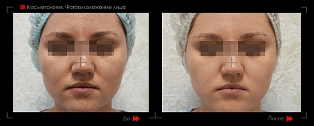 Фотоомоложение фото до и после процедуры