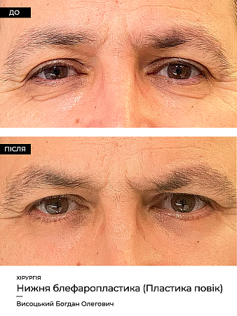 Блефаропластика 13 фото до и после процедуры