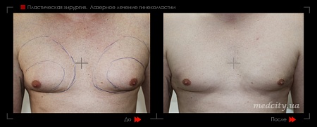 Гинекомастия фото до и после процедуры