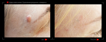 Удаление родинок 73 фото до и после процедуры