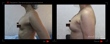 Замена грудных имплантов2 фото до и после процедуры
