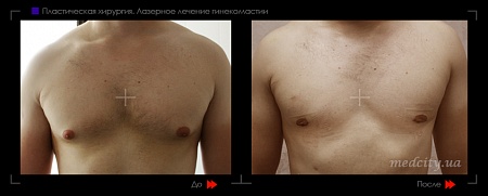 Гинекомастия 10 фото до и после процедуры