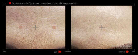 Шлифовка рубца 15 фото до и после процедуры