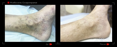 Склеротерапия 22 фото до и после процедуры