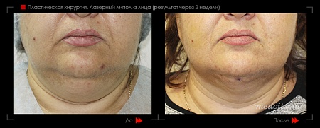 Липолиз лица 13 фото до и после процедуры