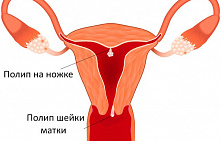Удаление полипа в матке
