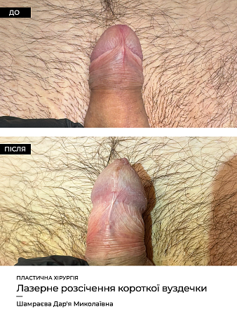 Френулотомия лазером (пластика уздечки) 12 фото до и после процедуры