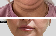 Липосакция подбородка