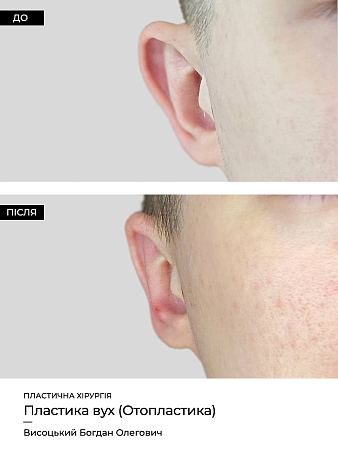 Отопластика фото до и после процедуры