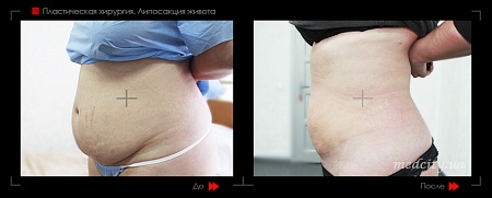Липосакция живота фото до и после процедуры