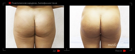 Липофилинг тела 5 фото до и после процедуры