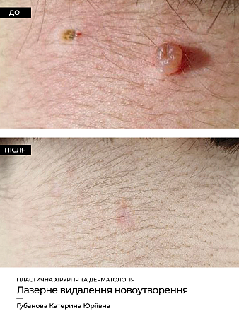 Удаление родинок 80 фото до и после процедуры