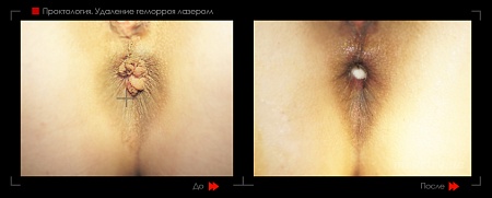 Удаление геморроя лазером 12 фото до и после процедуры