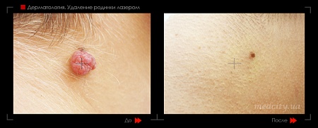Удаление родинок16 фото до и после процедуры