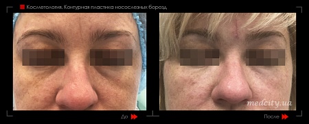 Контурная пластика носослезных борозд фото до и после процедуры