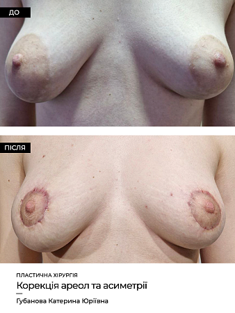 Коррекция ареол фото до и после процедуры