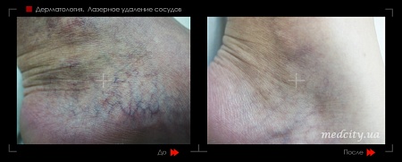 Лазерное удаление сосудов 6 фото до и после процедуры