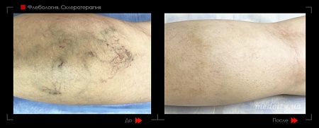 Склеротерапия 23 фото до и после процедуры