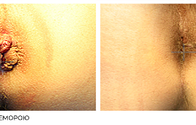 Лазерная вапоризация геморроя