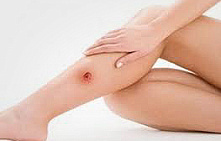 Лечение трофических язв без операции