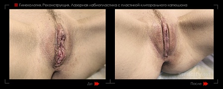 Лабиопластика 47 фото до и после процедуры