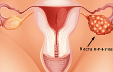 Диагностика и лечение кисты яичника