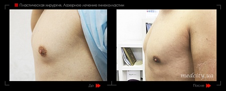Гинекомастия 49 фото до и после процедуры