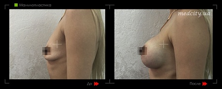 Маммопластика 3 фото до и после процедуры