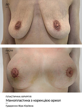 Мамопластика з корекцією ареол фото до и после процедуры